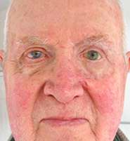 Custom orbital prosthesis