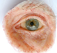 Custom orbital prosthesis