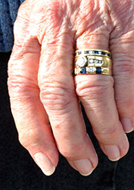 Custom left index finger prosthesis