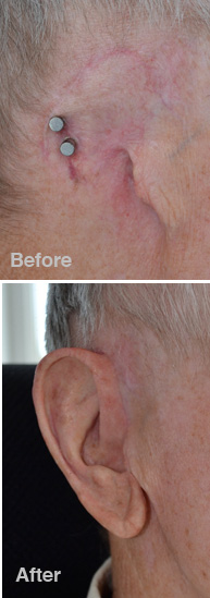 Custom implant retained ear prosthesis